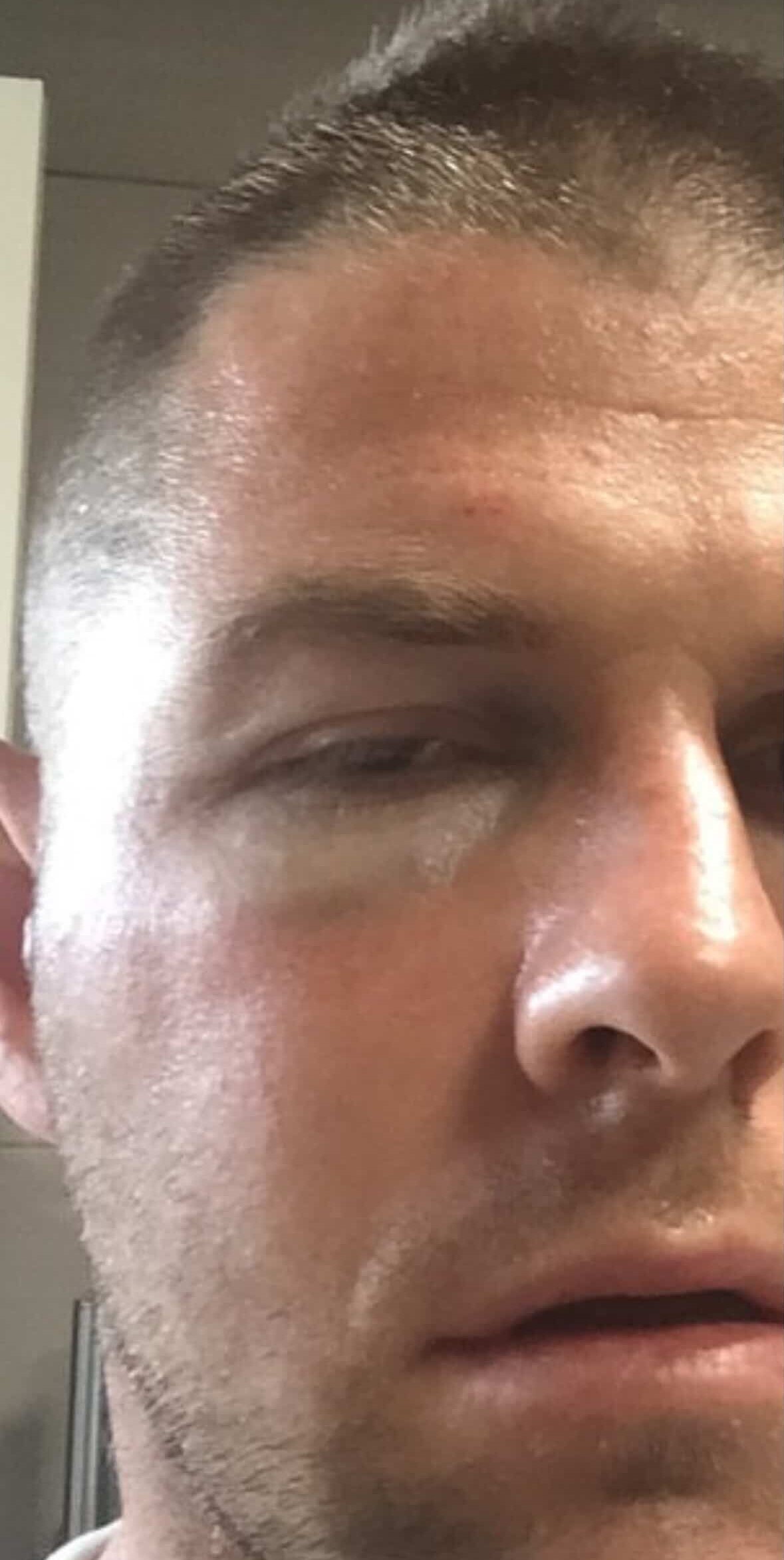 Close-up of a man's face with a bruised puffy eye