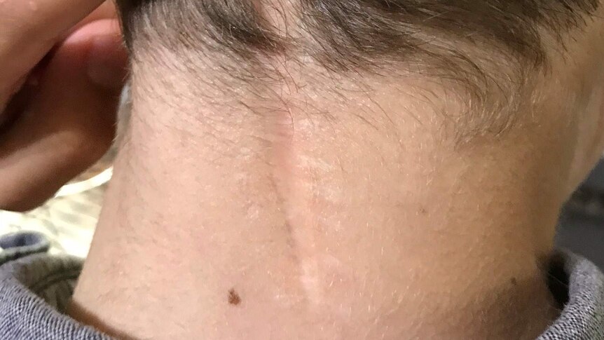 A close-up on the back of a young boy's neck shows a scar emerging from the hairline.