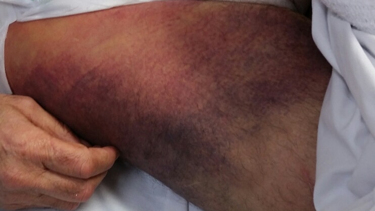 Bruises on Bob Spriggs' legs
