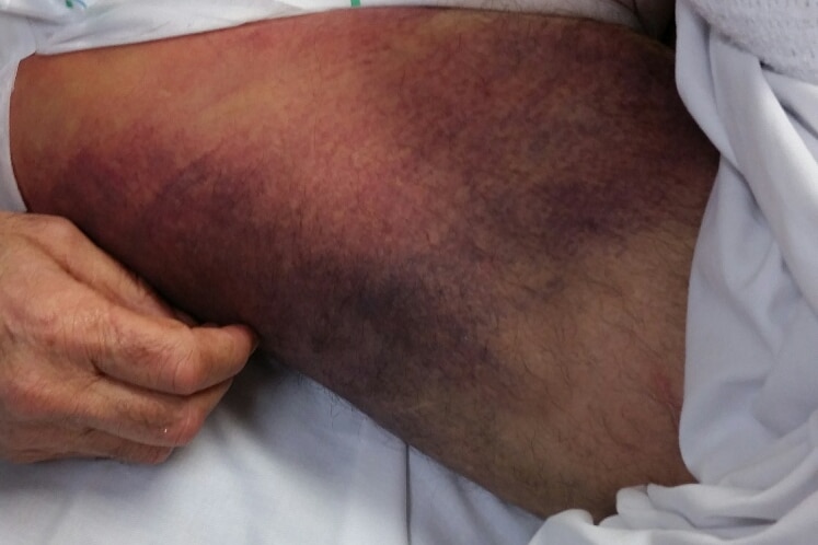 Bruises on Bob Spriggs' legs