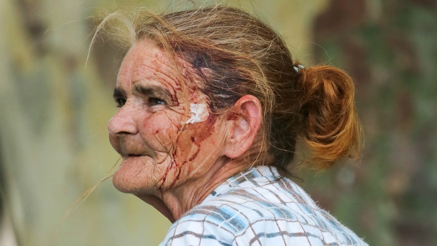 A woman with blood on her face.