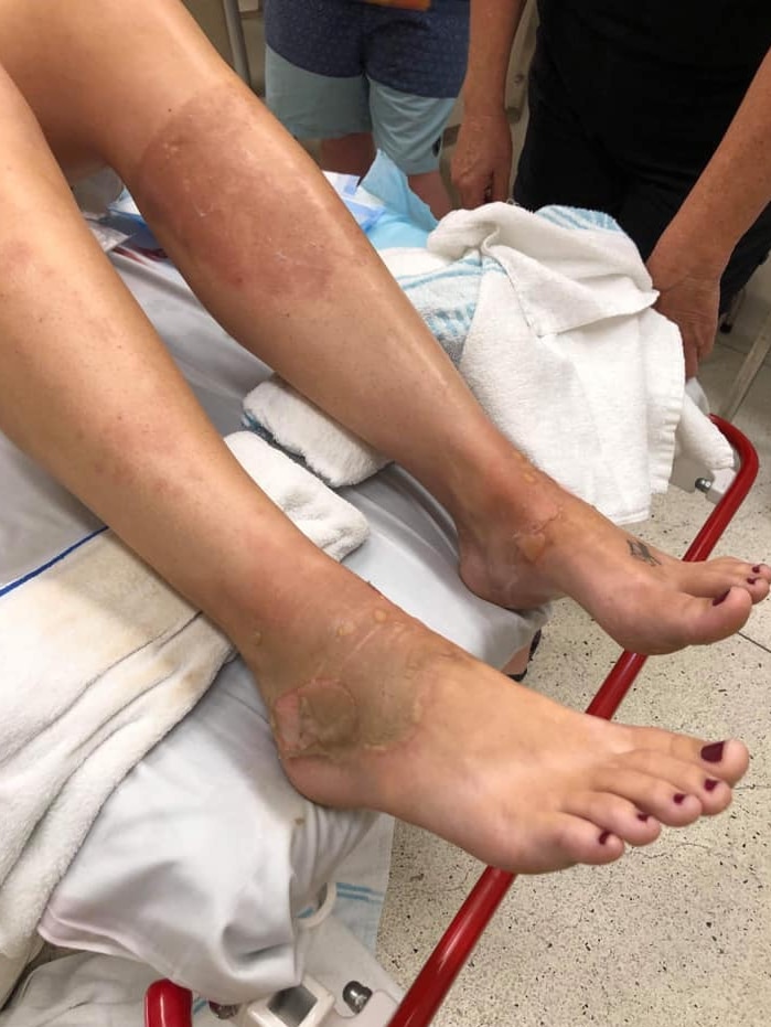 A woman's legs on a hospital bed showing severe burns on her ankles.