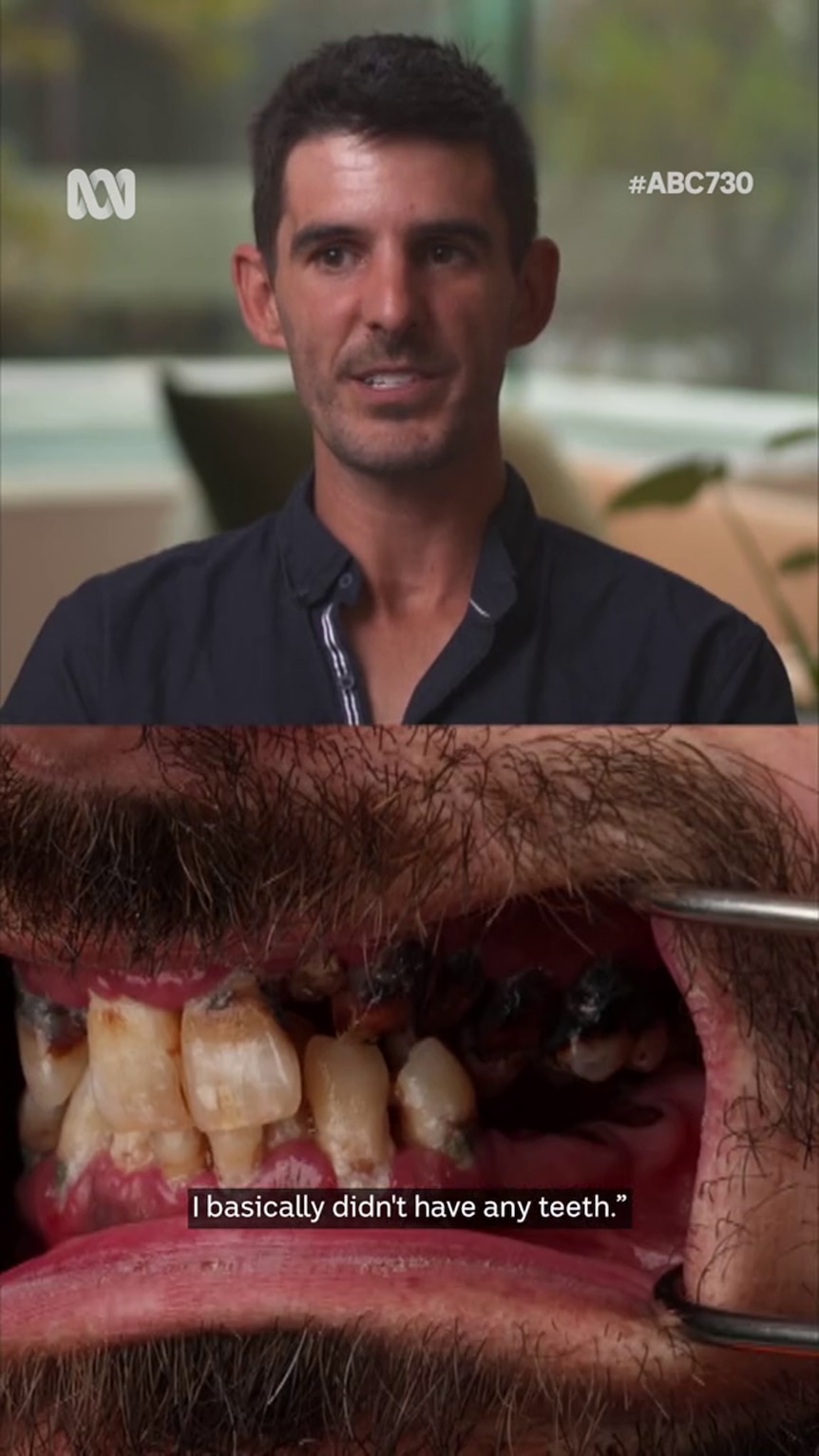 Composite shows photo of man with light skin tone and straight teeth, and a shot of teeth in poor condition