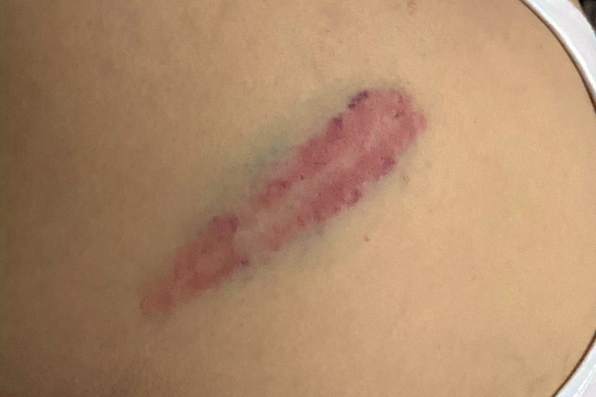 A photo of a red and blue bruise on the back of a shoulder.