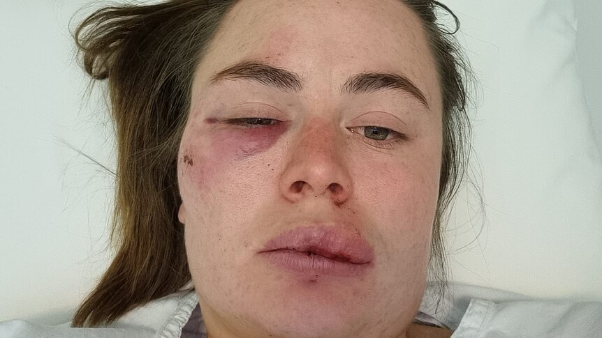 sissy austin in hospital following attack