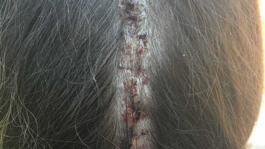 the back of a woman's head with a large surgical scar down the centre.