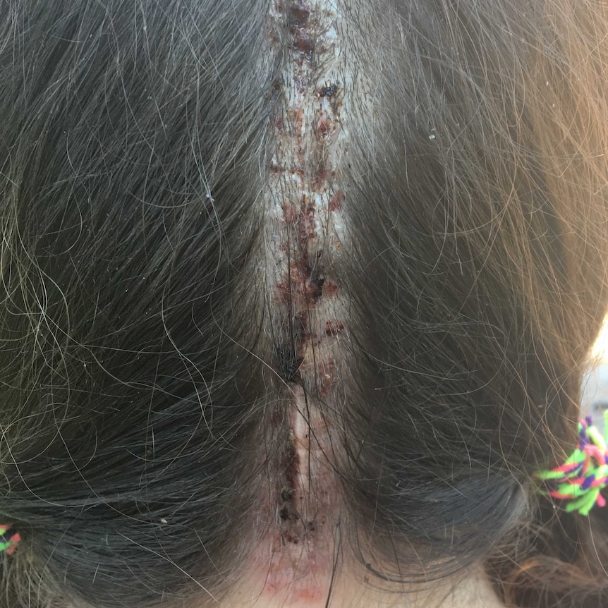 the back of a woman's head with a large surgical scar down the centre.