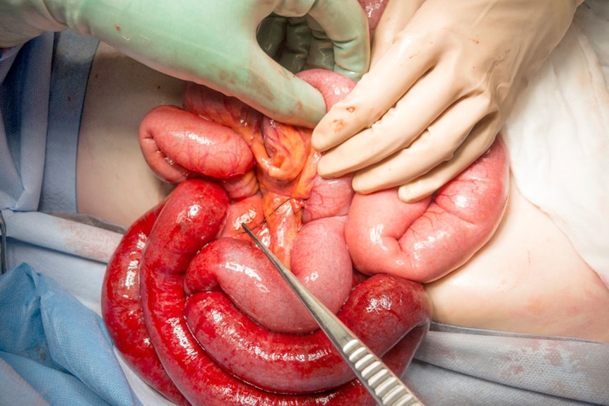 Intraoperative photograph of the orthodontic wire embedded in the small bowel
