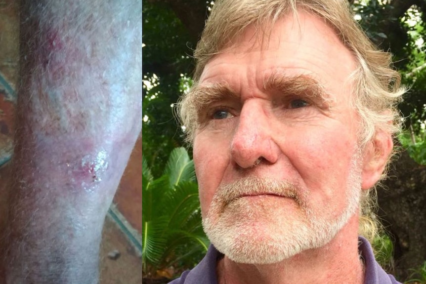 A headshot of Bob Creek standing in front of trees and a close up photo of a leg with a wound.