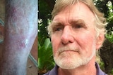 A headshot of Bob Creek standing in front of trees and a close up photo of a leg with a wound.