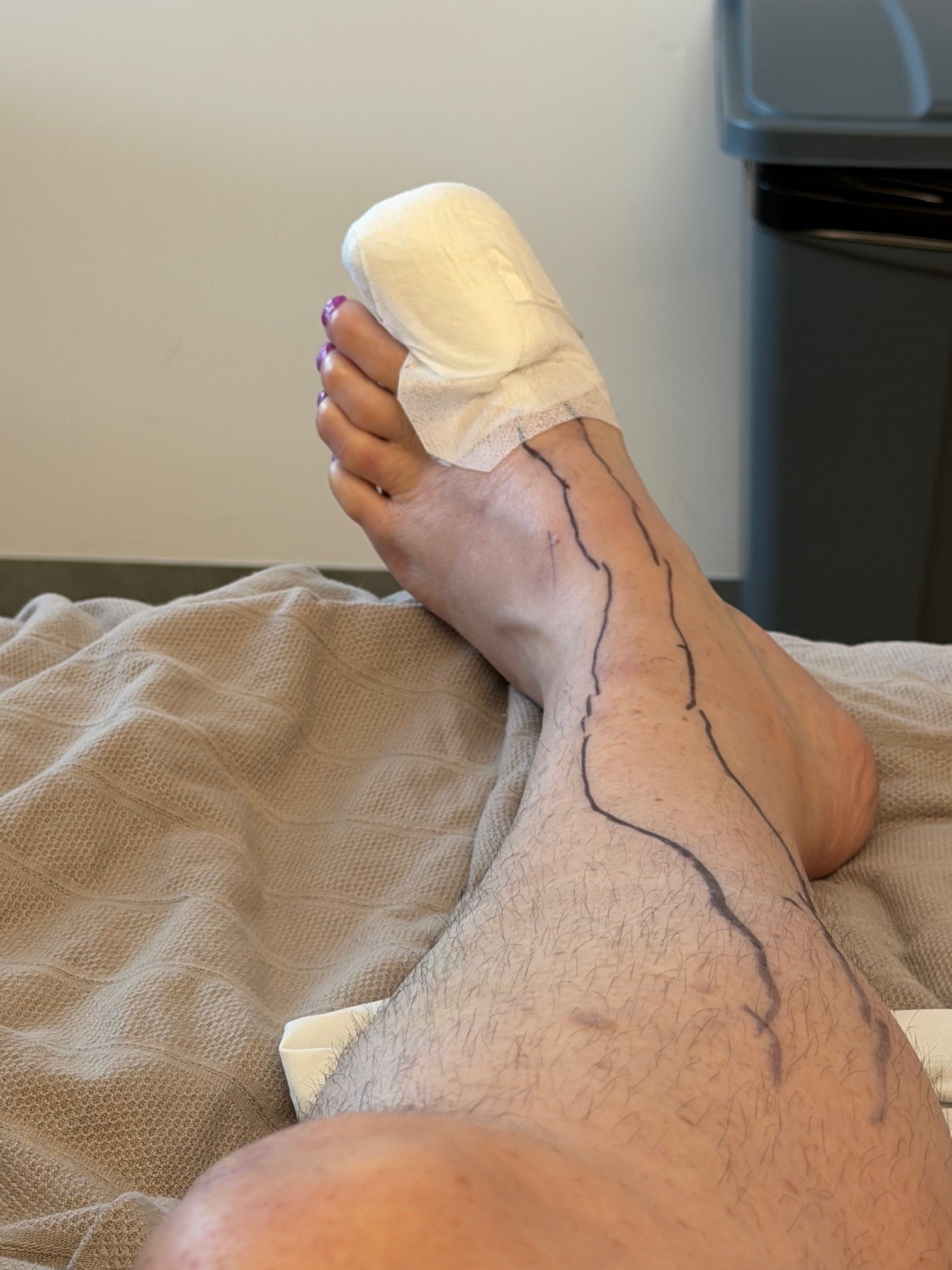 Perth woman warns about pedicure safety after severe infection