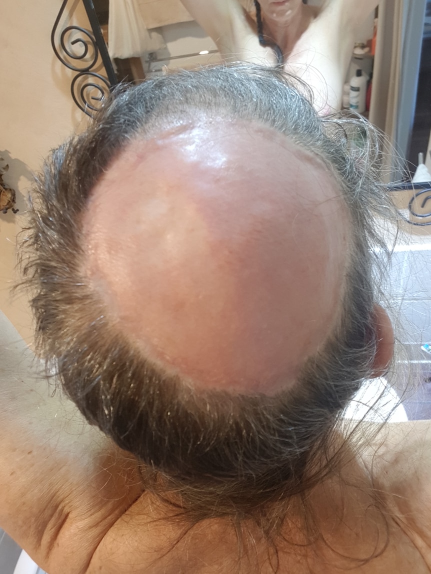 A photo of Pia Winberg's bald scalp a few months after her injury.