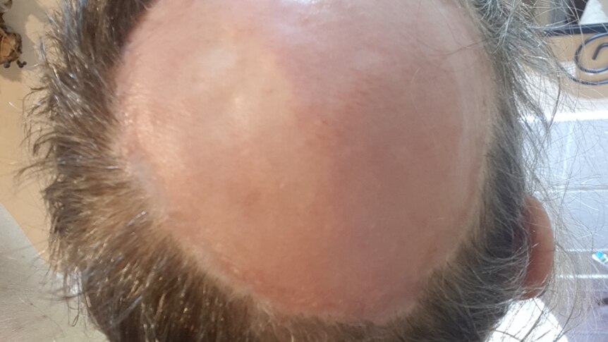 A photo of Pia Winberg's bald scalp a few months after her injury.
