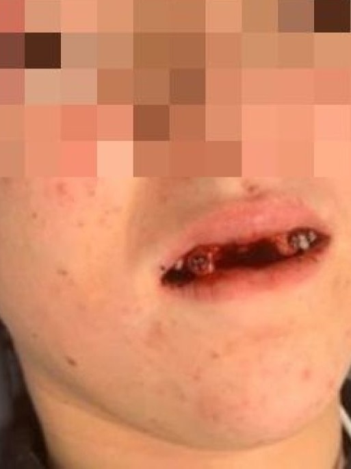 A pixelated photo of a young assault victim after losing teeth.
