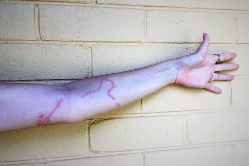 An outstretched arm against a breezeblock wall. The arm is scarred.