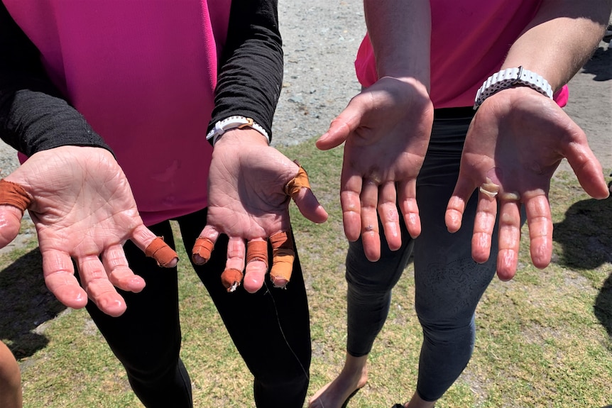 Women hold their hands out showing bandages and blisters