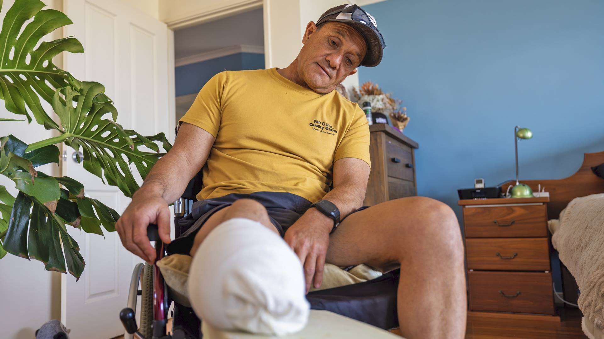 A man in a wheelchair looks down at his amputated, bandaged leg. Taken close to his leg.