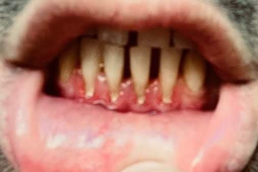 A close picture of a mouth shows thin teeth and receeding gums.