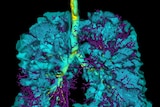 An MRI image showing damage inside lungs