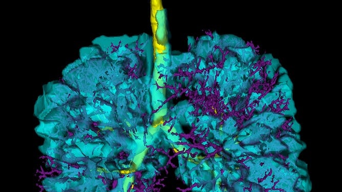 An MRI image showing damage inside lungs