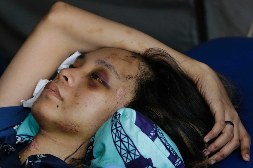 Indonesian woman Anisa Cornelia is badly cut and bruised after the tsunami on the island of Sulawesi.