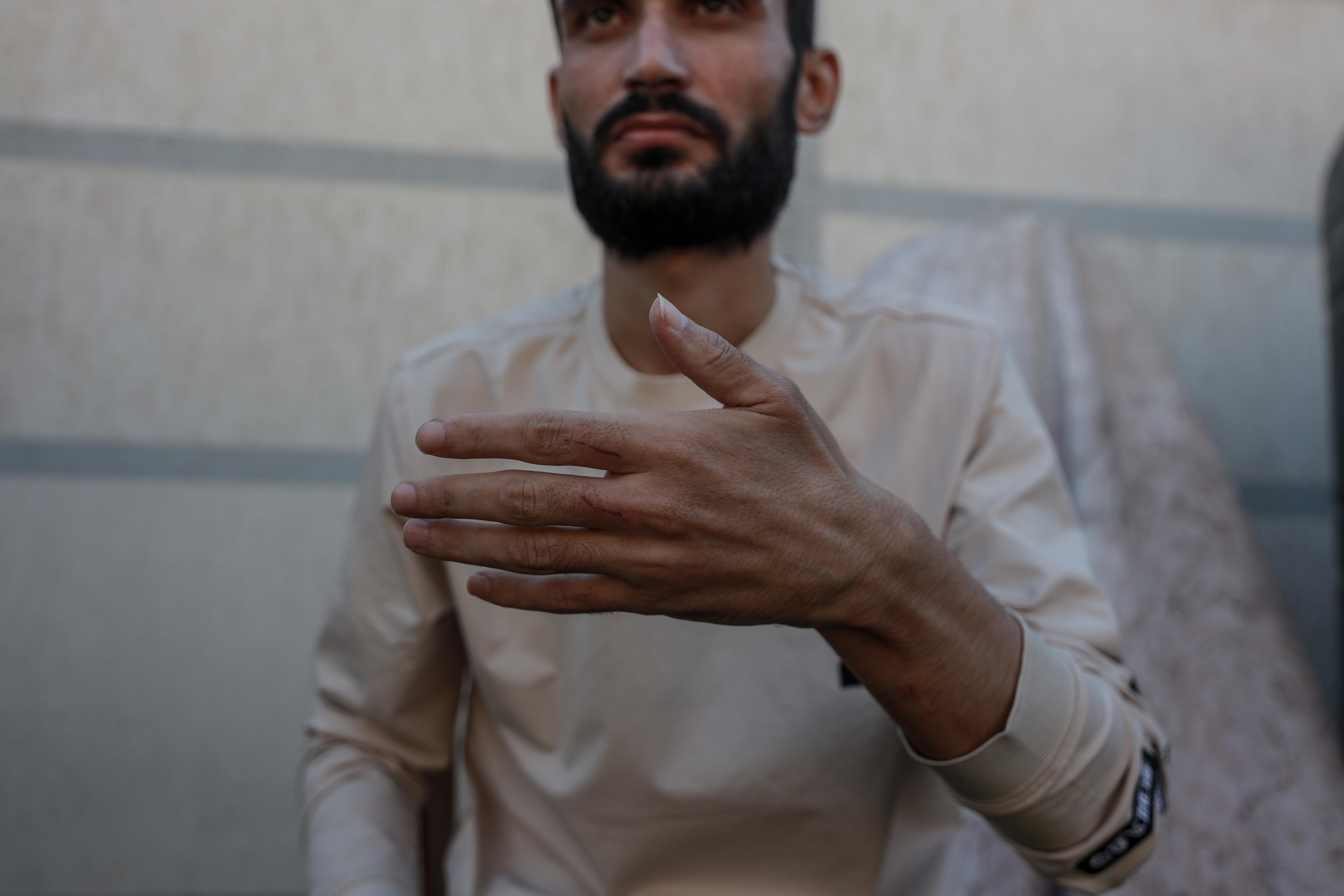 A freed Palestinian detainee shows marks on his hand.