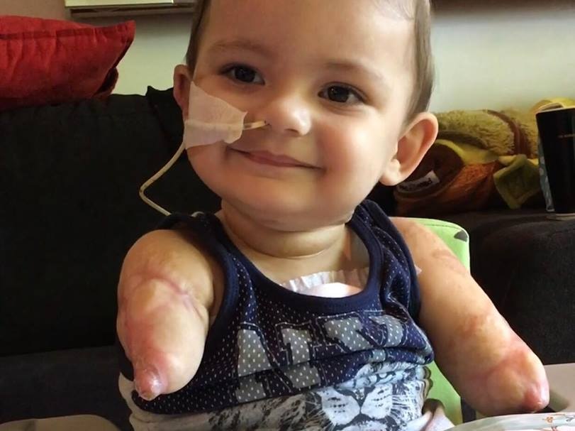 Robbie aged about 1 smiles in front of a book. He is missing both arms and has a gastric feeding tube in his nose.