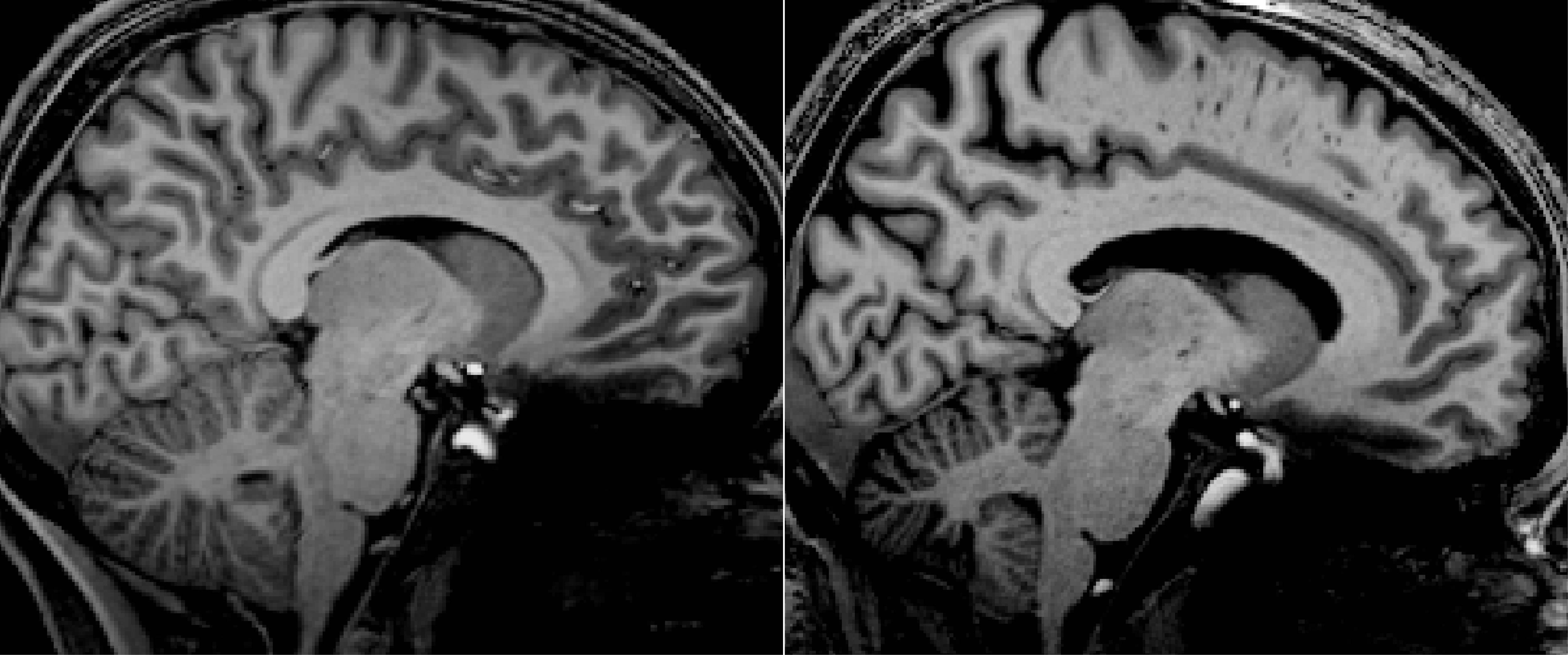 two black-and-white xray-generated images of brains