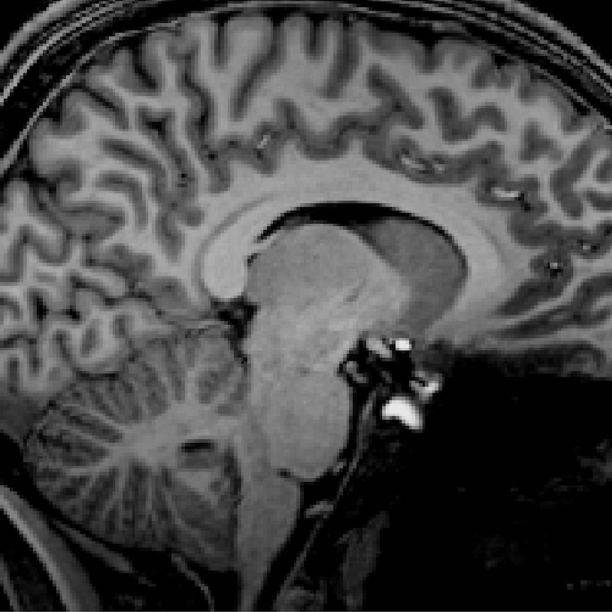 two black-and-white xray-generated images of brains