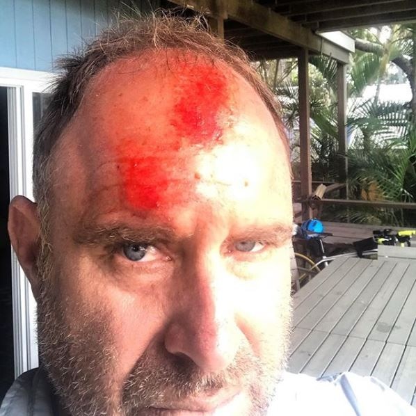 Former cricketer Matthew Hayden shows his head injuries after being dumped by a wave on Stradbroke Island.