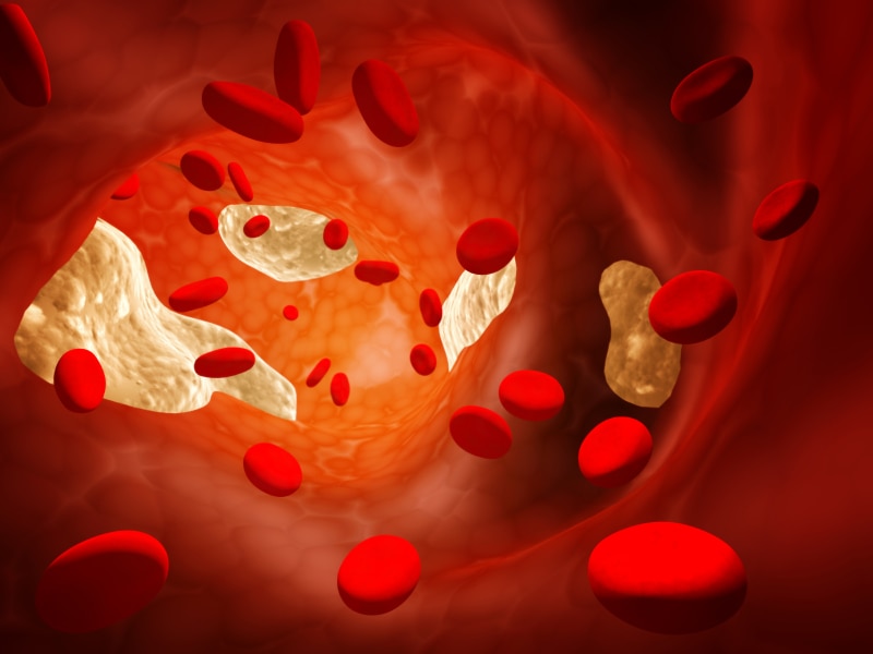 Australians cut back on or stopped taking statins following ABC ...
