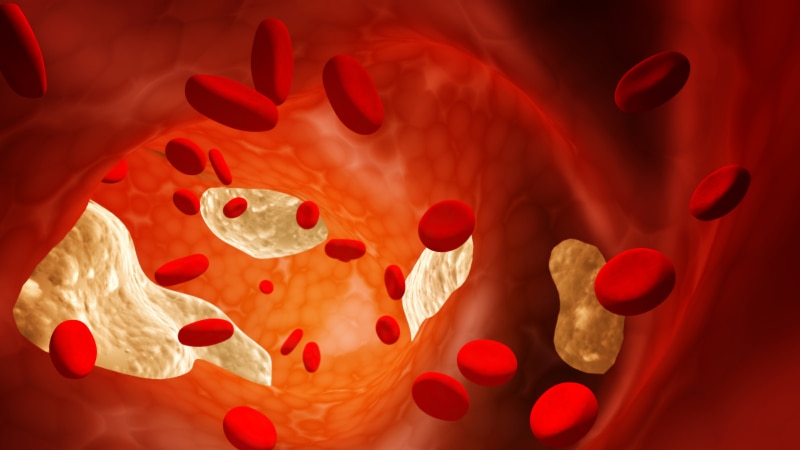 A computer generated rendering of cholesterol in an artery causing atherosclerosis.