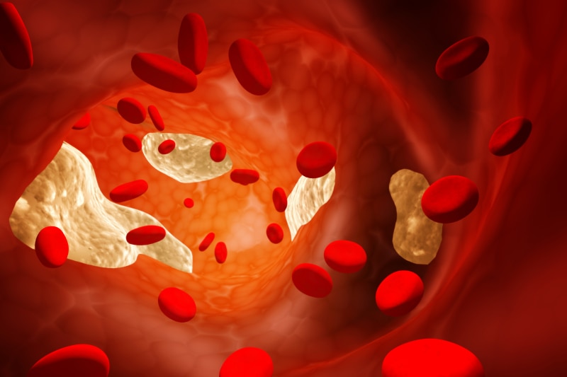 Computer image of red blood cells and cholesterol