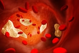 A computer generated rendering of cholesterol in an artery causing atherosclerosis.