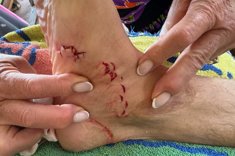 Shark teeth puncture wounds on a man's ankle.