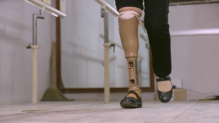 Low cost prosthetics trial in Vietnam