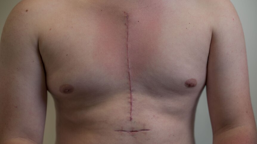 Scars on the chest of Hamish Pownall after open heart surgery. Photo by Margaret Burin.