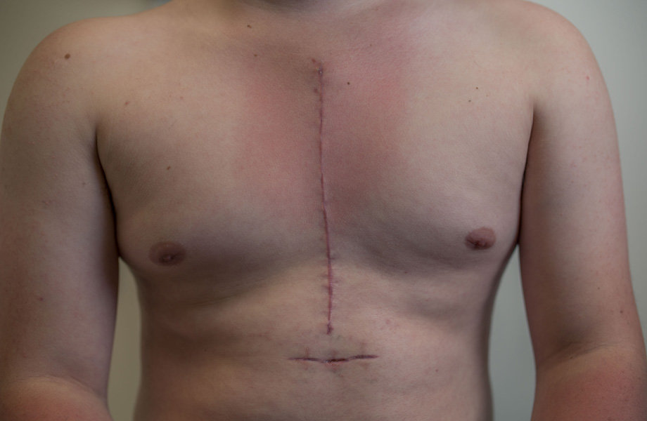 Scars on the chest of Hamish Pownall after open heart surgery. Photo by Margaret Burin.