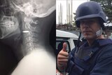 A composite image of an x-ray showing a bullet lodged in Adam Havey's neck and Adam Harvey with a helmet on giving the thumbs up