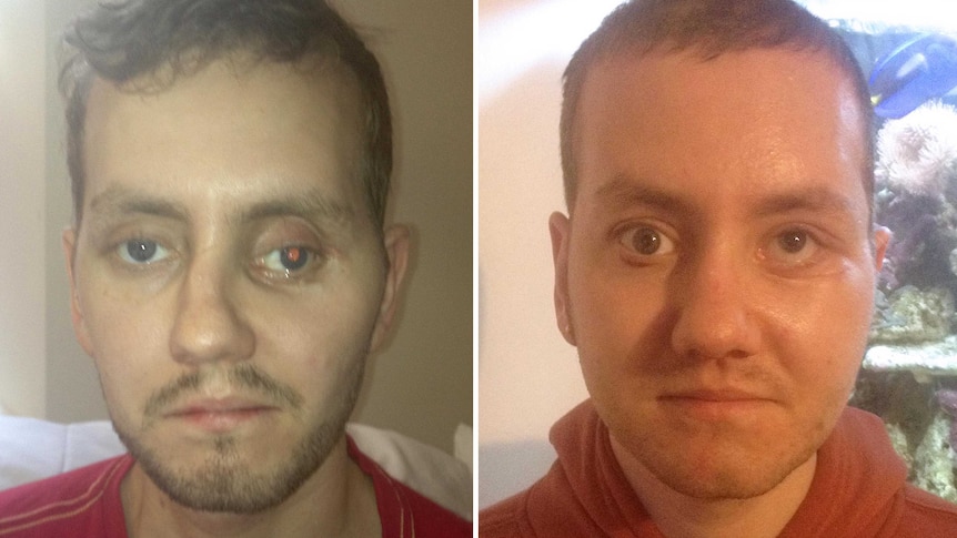 Before and after shot of British man Stephen Power who had facial reconstruction surgery using 3D printed parts