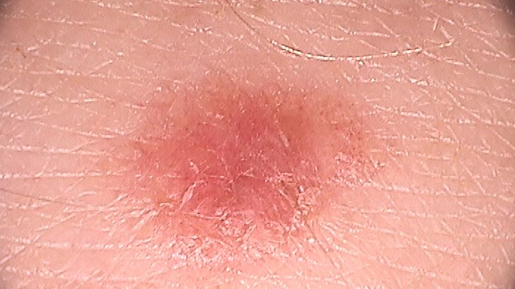 Close up of Rachel Argus' pale melanoma