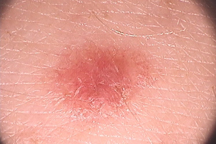 Close up of Rachel Argus' pale melanoma