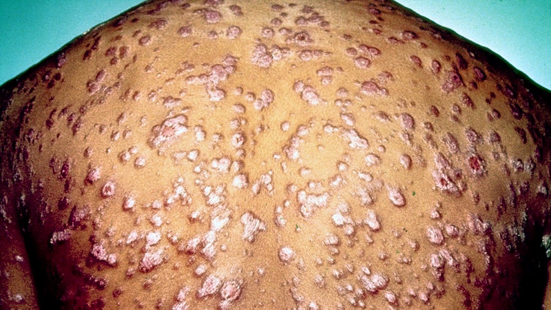 The back of a man with syphilis reveals numerous lesions.