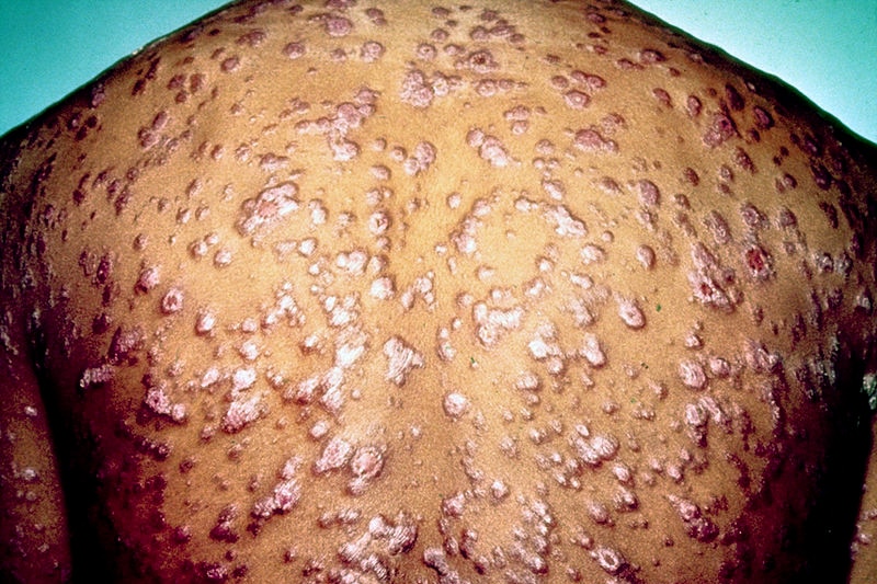 The back of a man with syphilis reveals numerous lesions