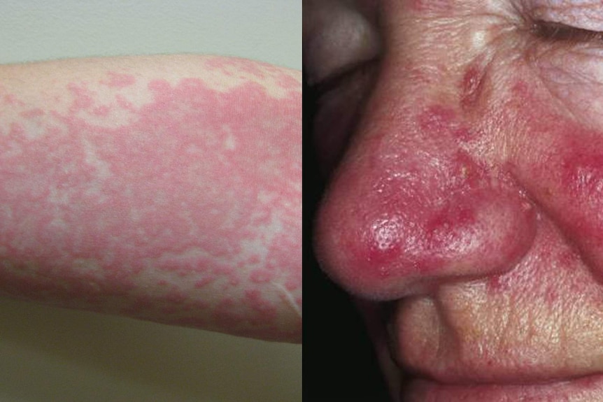 A composite image of two skin conditions, urticaria and rosacea.