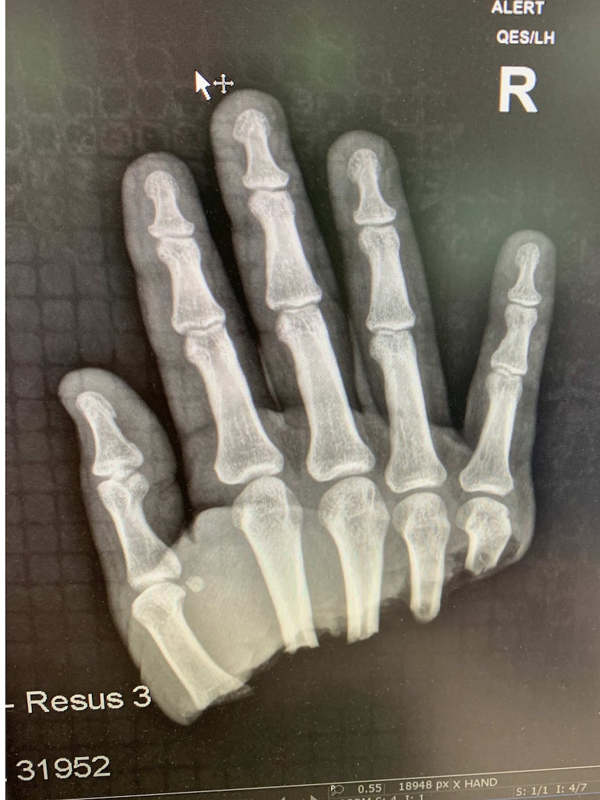 An x-ray showing a hand severed above the wrist but below the fingers.