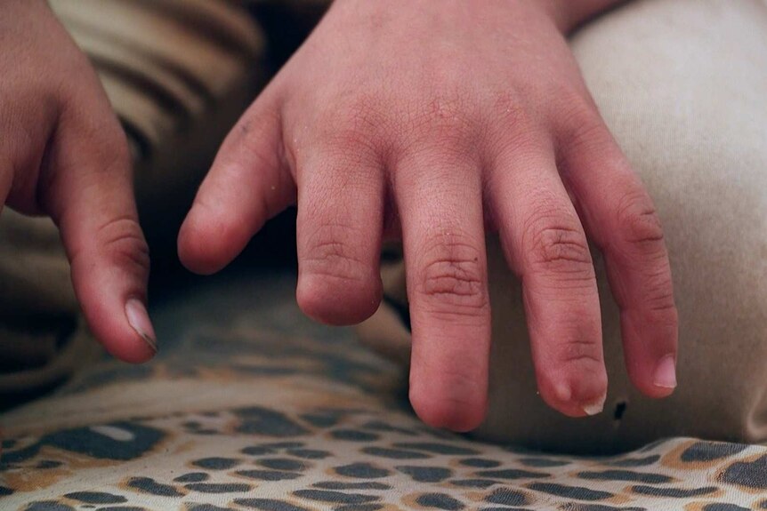 Abdullah, 12, shows his hands — his fingertips were blown off when he touched an unexploded grenade.