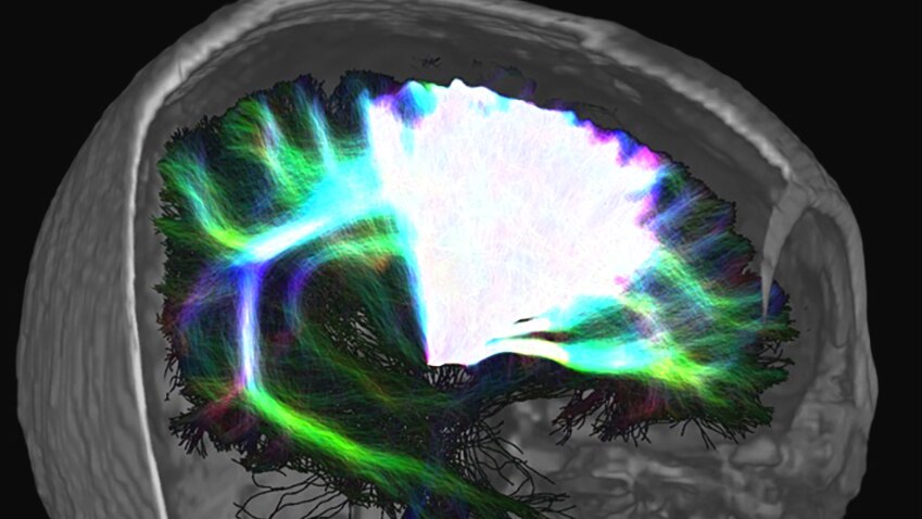 A diffusion MRI image taken as part of a QIMR Berghofer study into Parkinson's disease medicine and risk-taking behaviour.