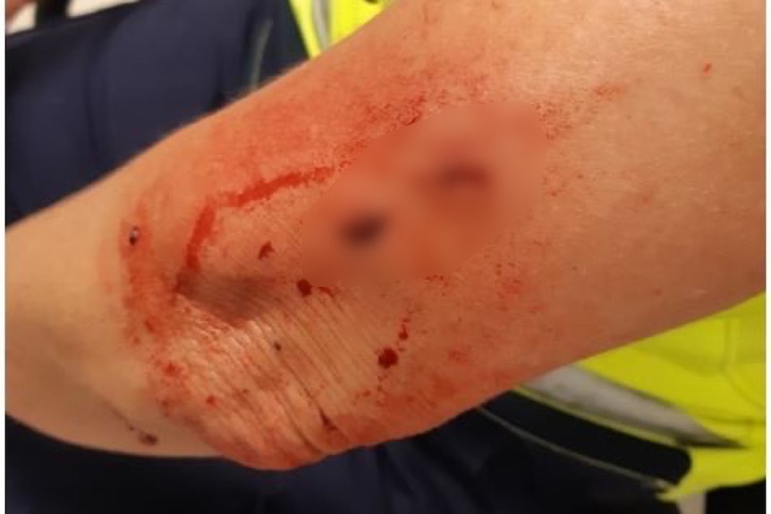 Bloody wound on the back of a posties' arm from a dog bite
