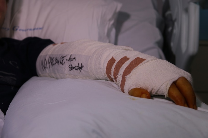 Sean Whitcombe's arm in a cast in the Royal Darwin Hospital.